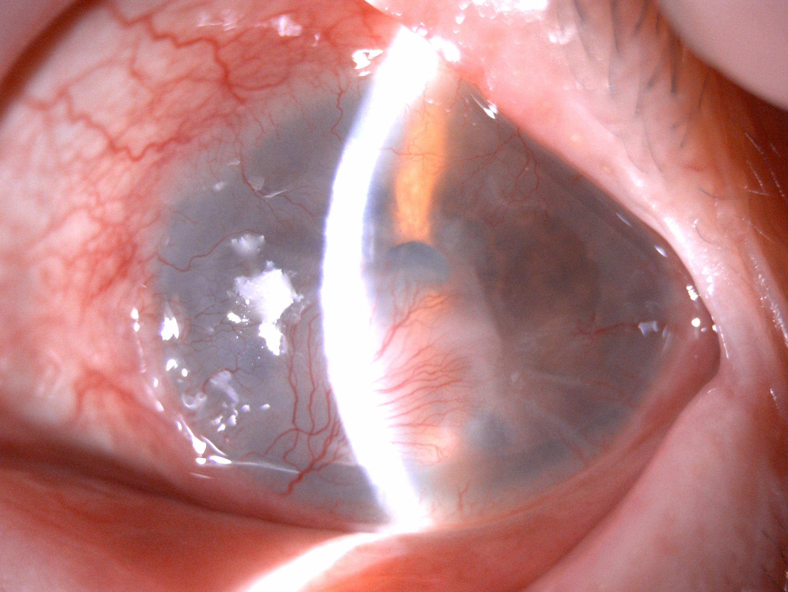 角膜不好还能做晶体植入吗,角膜不好能做近视手术吗