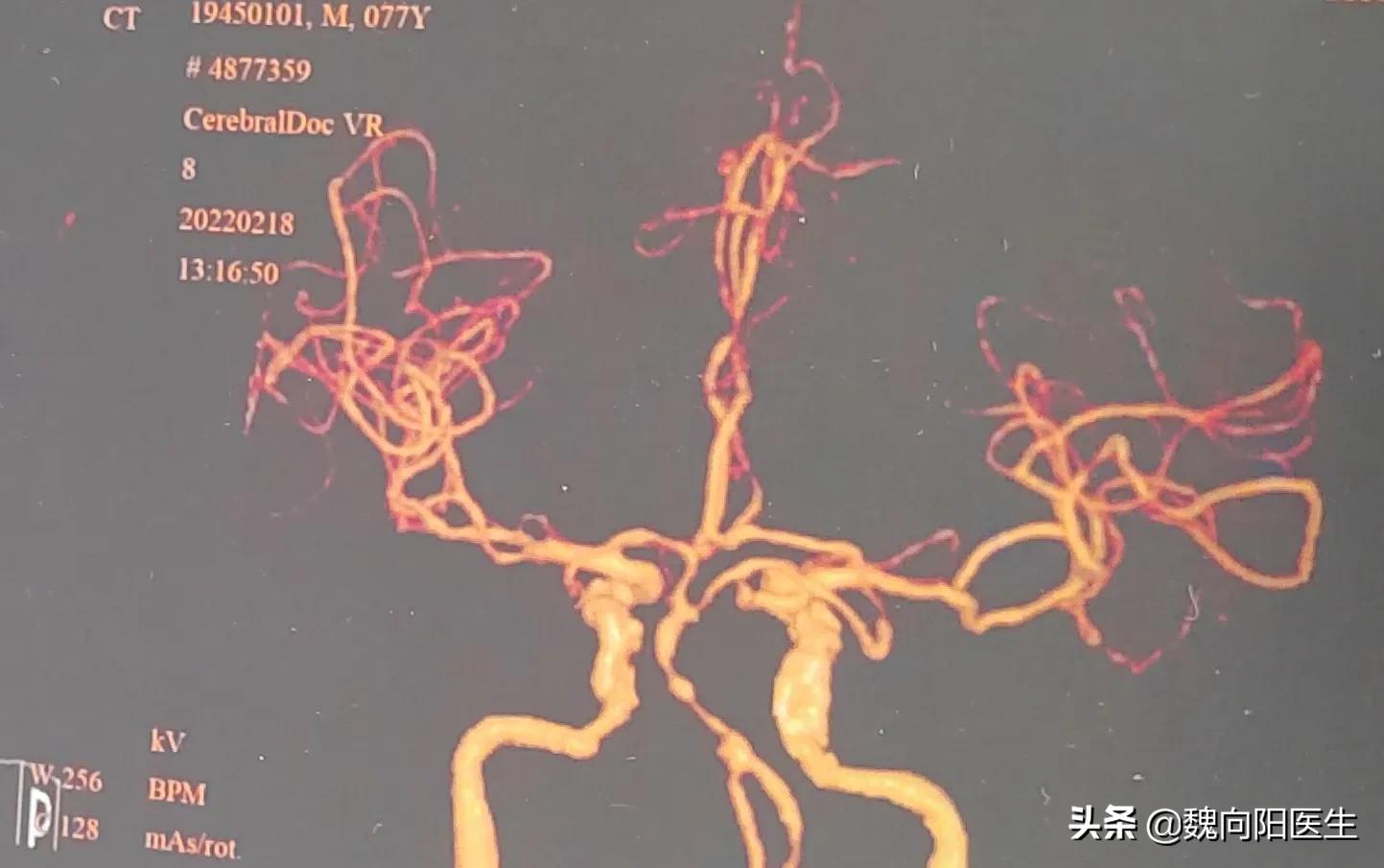 脑动脉狭窄需要血管搭桥吗,脑动脉狭窄不吃药行吗