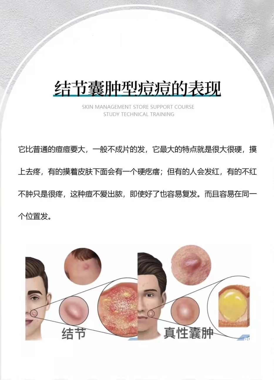 结节性痘痘怎么防止长痘坑,痘痘要变成痘坑了该怎么办