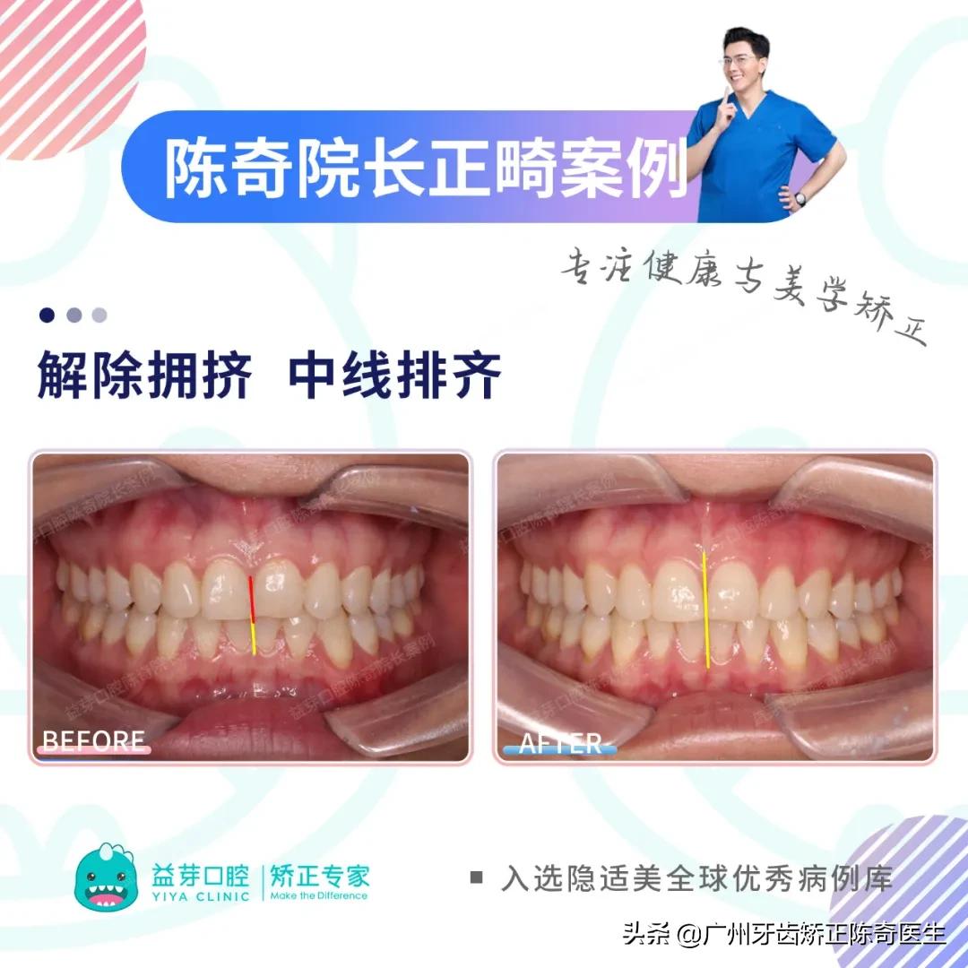 隐适美矫正和普通矫正的区别,隐适美矫正有几种版本