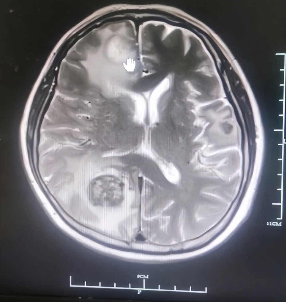 直肠癌晚期转移了好治疗吗,直肠癌晚期肺部转移了还能活多久