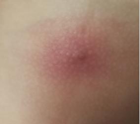 小孩皮肤有个红疙瘩里边有点硬块,小朋友皮肤上长疙瘩有白色脓包