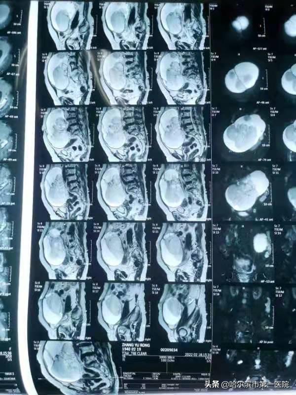 82岁老太肚子鼓包如足月孕妇原是“肿瘤”作怪—哈尔滨市第一医院妇二科利用“单孔腹腔镜”切除巨大卵巢肿瘤