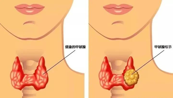 体检发现甲状腺结节，要治疗吗？会不会恶化？