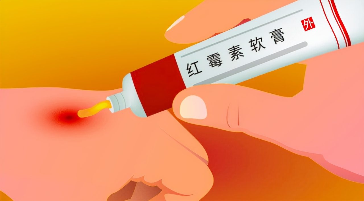 用红霉素软膏可以祛除老年斑吗,红霉素软膏消除老年斑