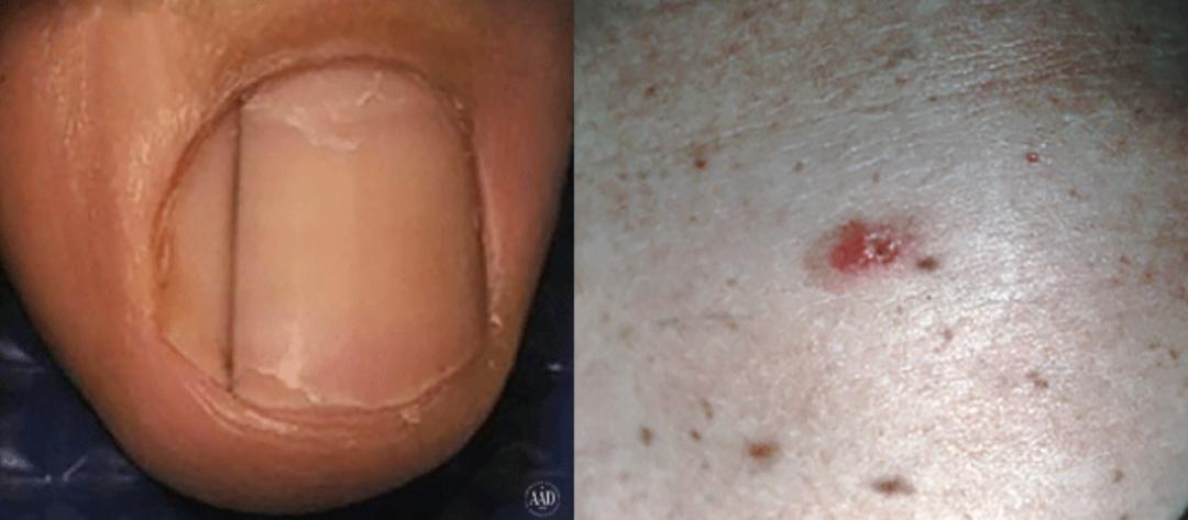 甲母痣癌变几率多大,多大的痣会癌变