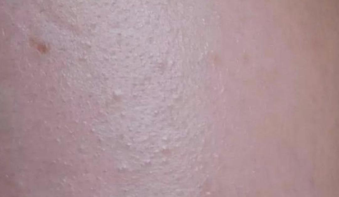 脸上疙疙瘩瘩但不是闭口,脸上疙疙瘩瘩是闭口吗