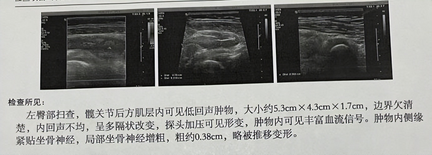 下肢肌间静脉畸形治疗案例,臀部静脉畸形怎么治疗比较好