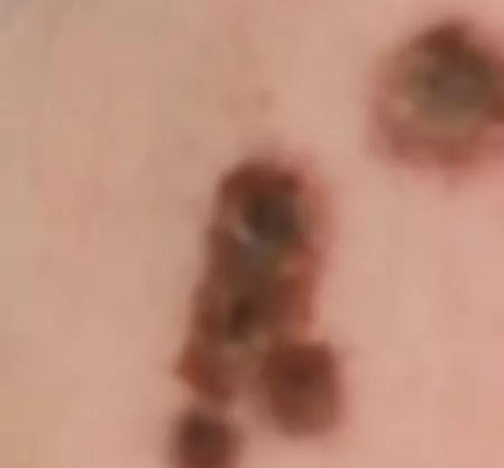 药水点痣烧伤,用药水点痣后留下的红疤怎么去除