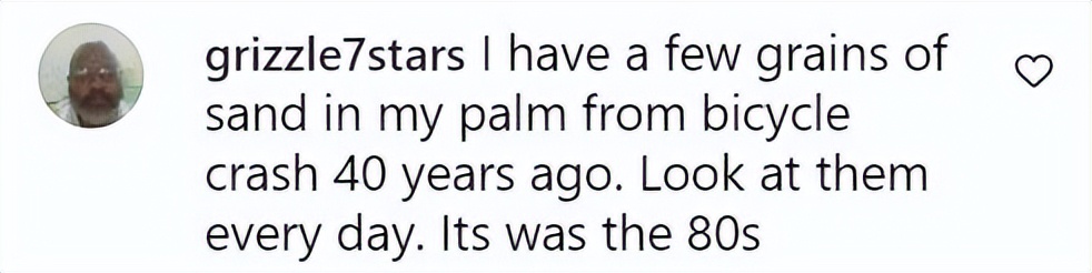 美国女子被橡皮子弹击中,女子手术取出戳20年铅笔芯