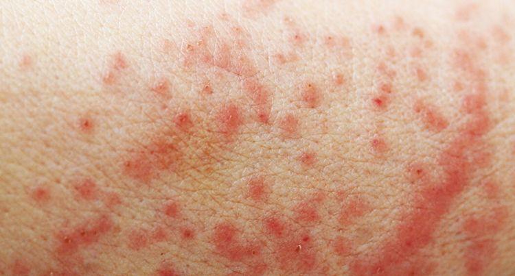 湿疹为什么不能彻底治愈,湿疹如何才能彻底的治愈