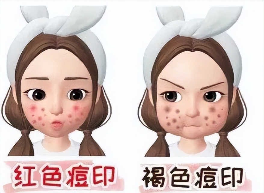 脸上到处是痘痘痘印痘坑怎么办,痘痘破了怎么处理不会留痘印痘坑