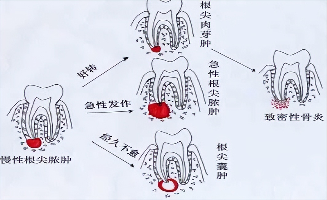 备孕会不会出现牙疼,牙出现大洞牙疼怎么办
