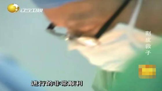 切肤之爱真实上演，河北妈妈割皮救子，就算割光全身的皮也不怕