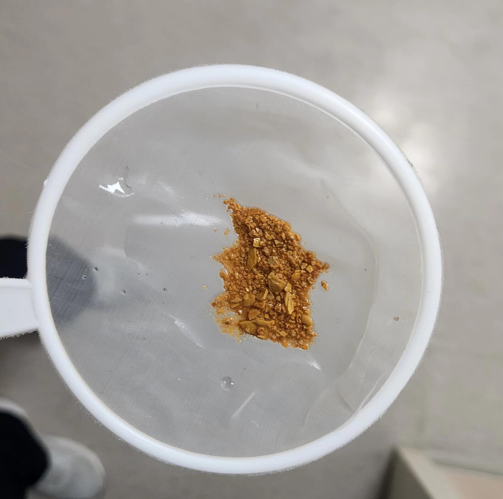 输尿管体外碎石后要注意什么,肾结石体外碎石出现腰疼注意事项