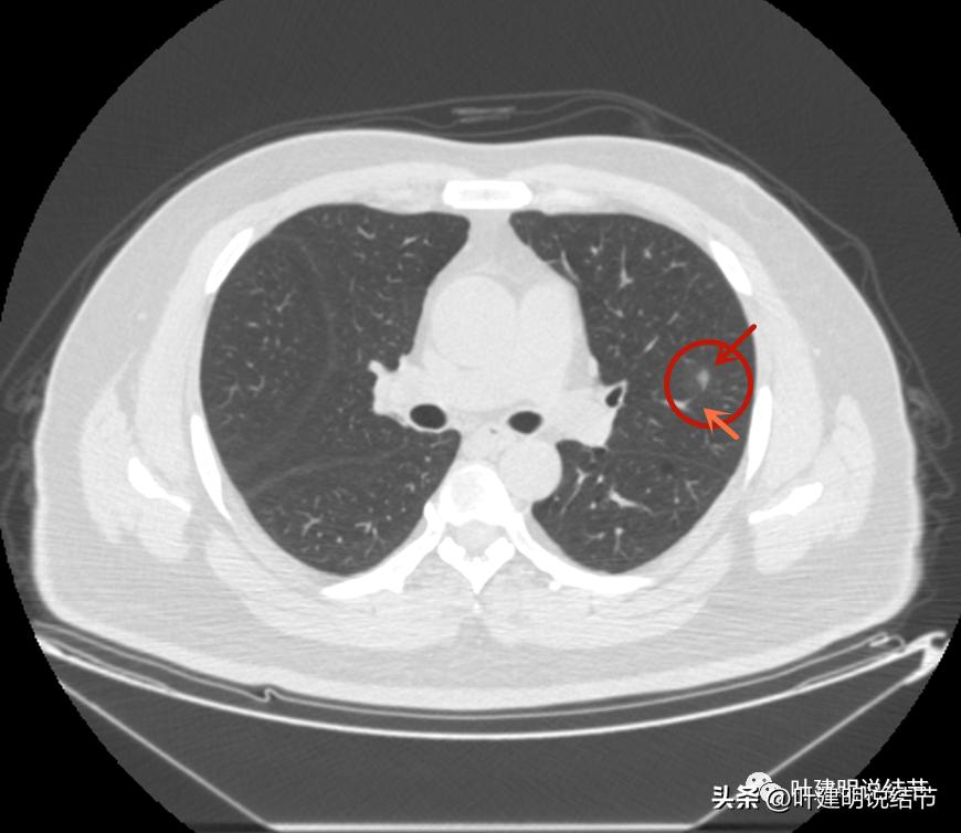 如何判断肺磨玻璃结节是高危结节,肺上有混合磨玻璃结节要注意什么