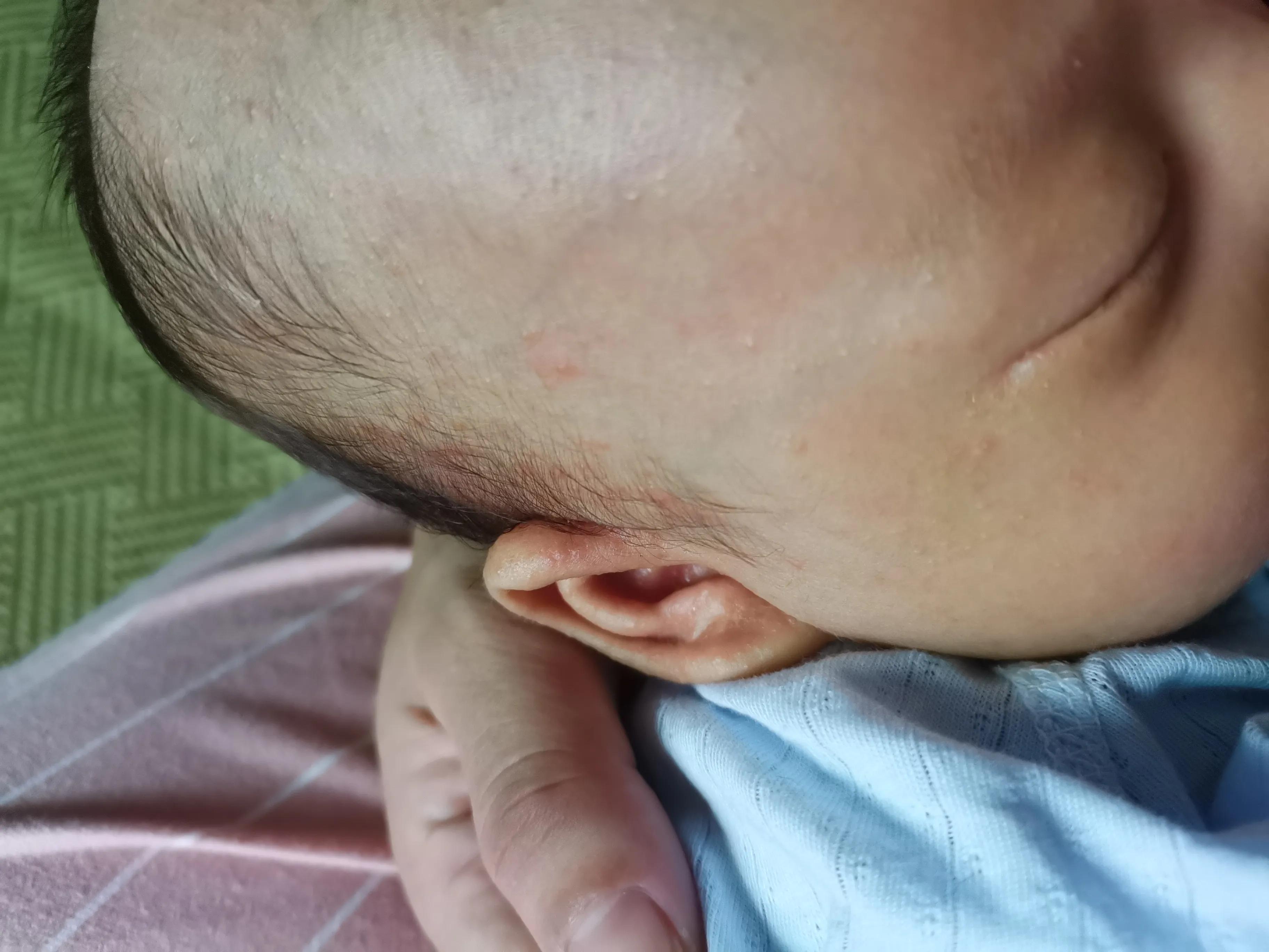 南方湿疹的最佳治疗方法,婴儿耳垂根部湿疹