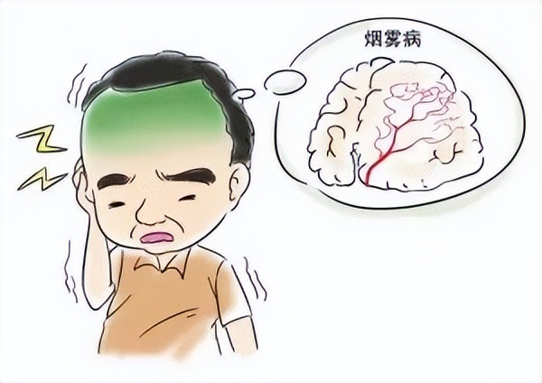 14宀佺敺瀛╃獊鐒剁儫闆剧梾,13宀佺敺瀛╃儫闆剧梾鎬庝箞寰楃殑