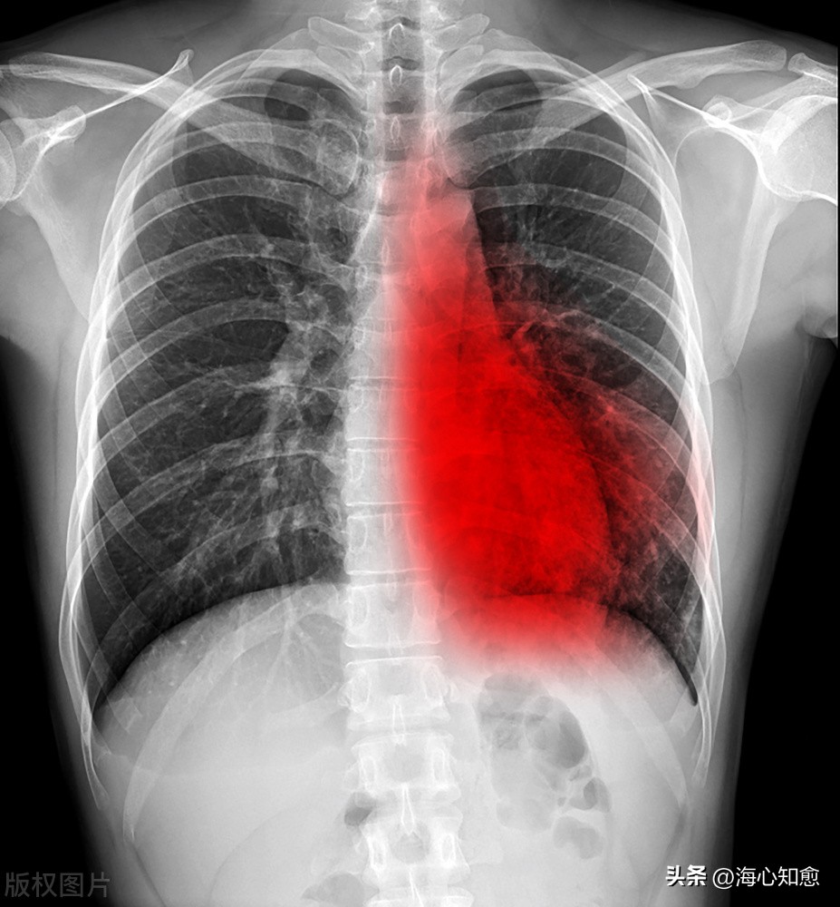 食管癌肝肺转移有必要治吗,食管癌术后脊柱转移预后