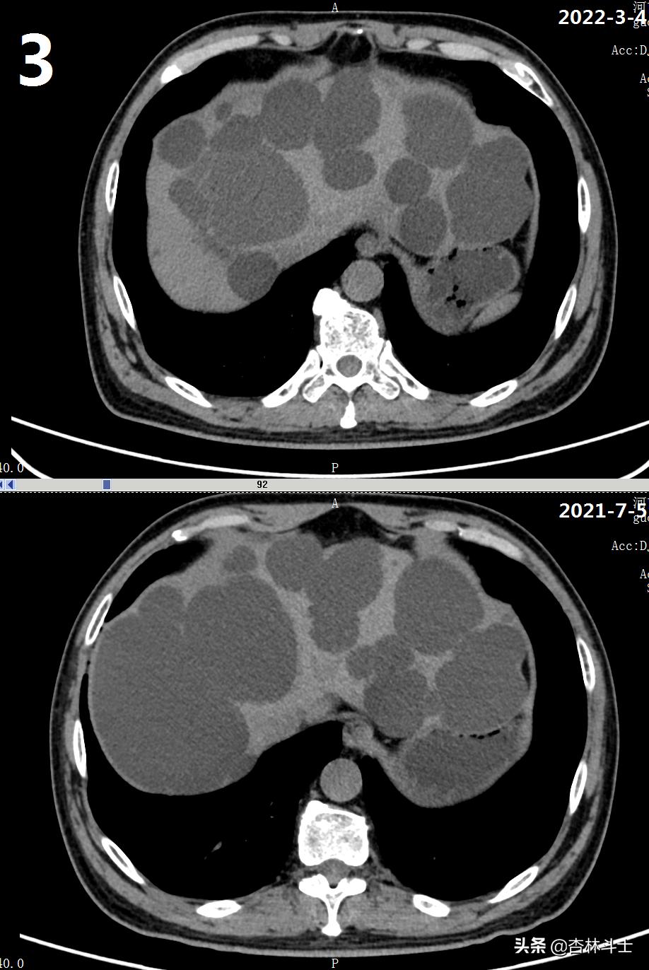 64岁银行职员患肝囊肿，CT引导下细针穿刺抽吸酒精硬化解决大问题
