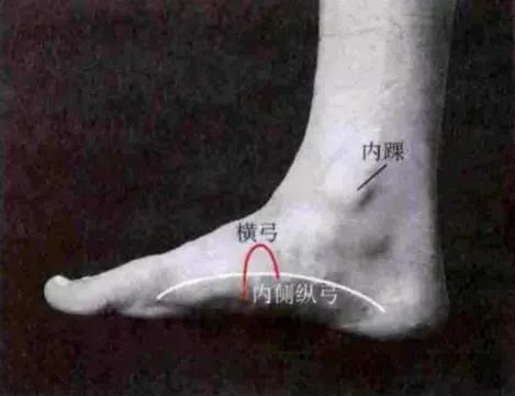 扁平足发病机制,扁平足诊断标准示意图