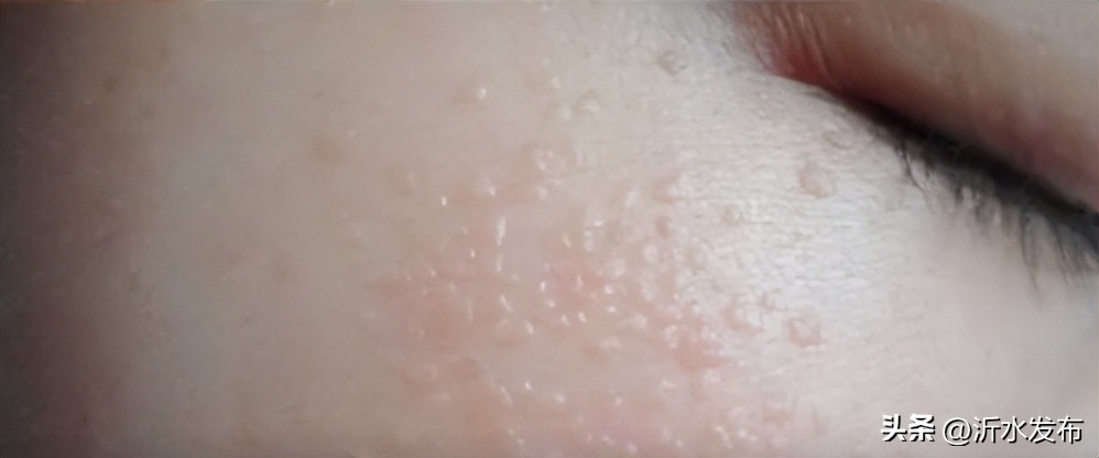 眼周长小小的疣,眼周长小丘疹是怎么回事