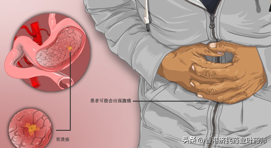 奥美拉唑治疗胃溃疡研究进展综述,奥美拉唑治疗胃溃疡研究文献综述