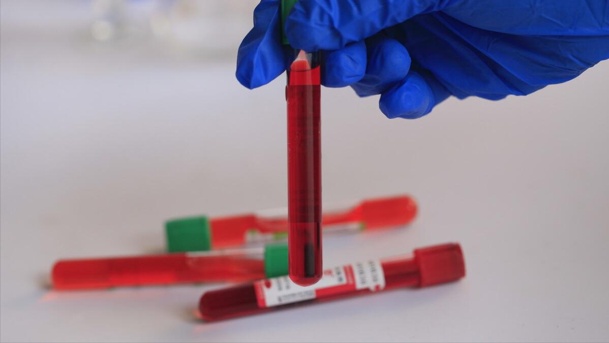 做什么检查可以看出肾病严重程度,要想知道肾有没有问题查什么