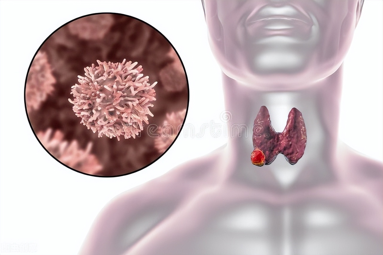 甲状腺有问题会导致贫血吗,甲状腺有问题会不会引起咳嗽
