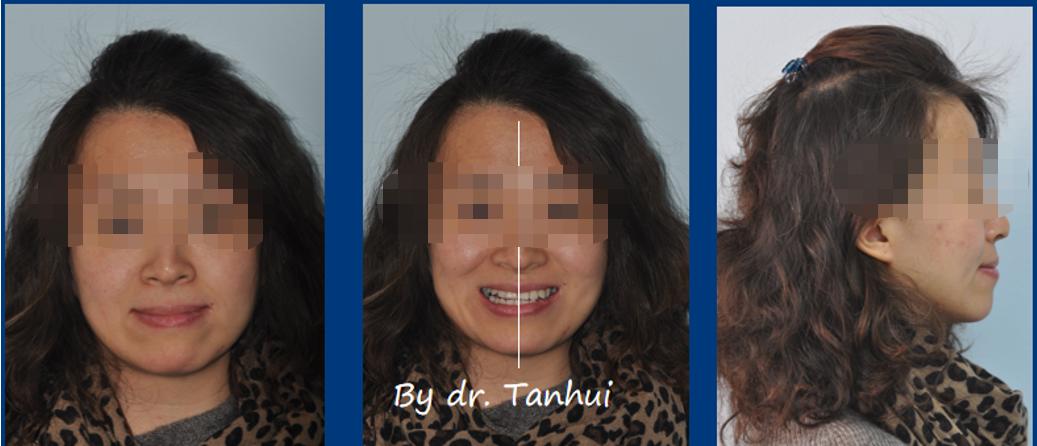 地包天能做手术矫正吗,儿童地包天矫正几岁做最好