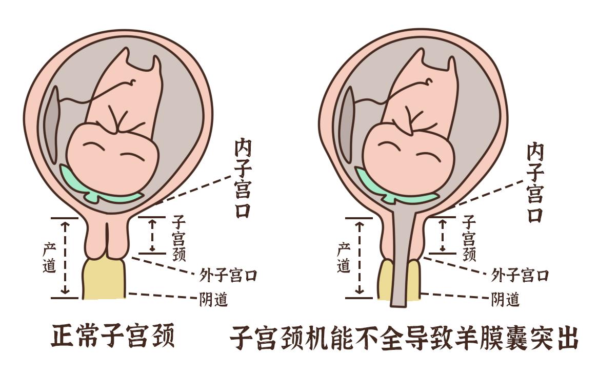 “一根线”兜住宝宝的生命大门！反复流产的妈妈报喜了
