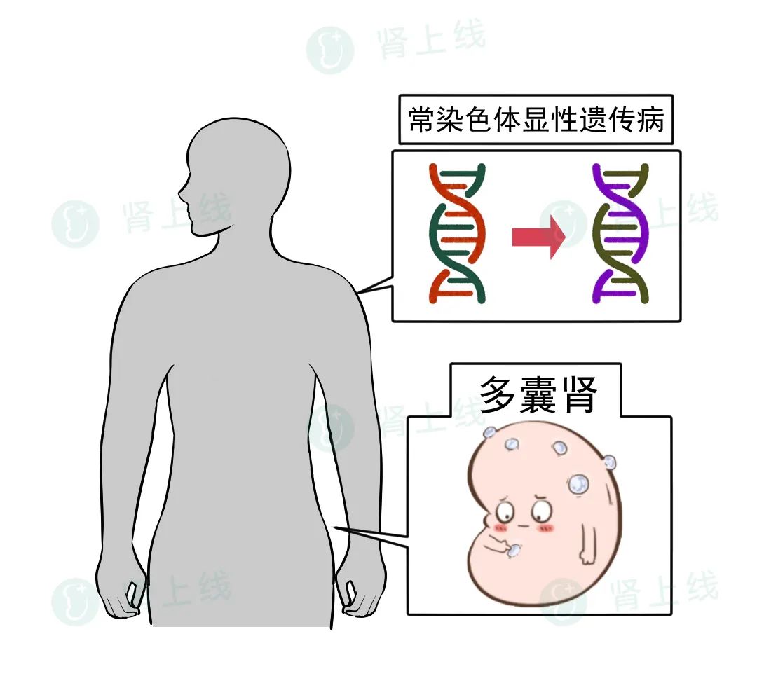 一家接连患尿毒症，是怎么回事？了解最常见的遗传性肾病-多囊肾