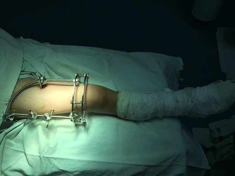 儿童股骨干粉碎性骨折对位不太好,儿童股骨干骨折石膏固定