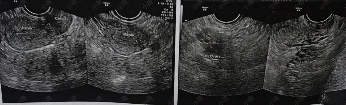 多囊卵巢综合征导致长痘怎么治疗,例假推后脸上爆痘多囊卵巢综合症