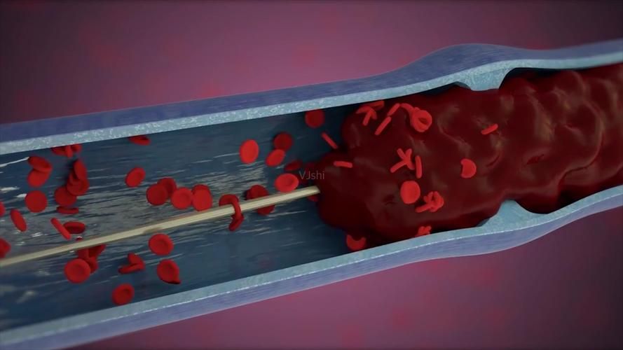 癌症引起腿血栓,孕妇如何预防血栓的发生