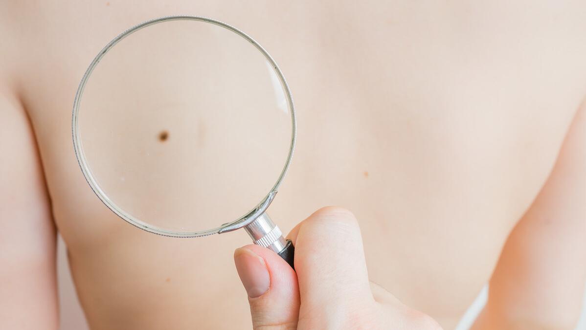 脸上长黑斑是癌症的前兆吗,脸上的黑斑会成皮肤癌吗