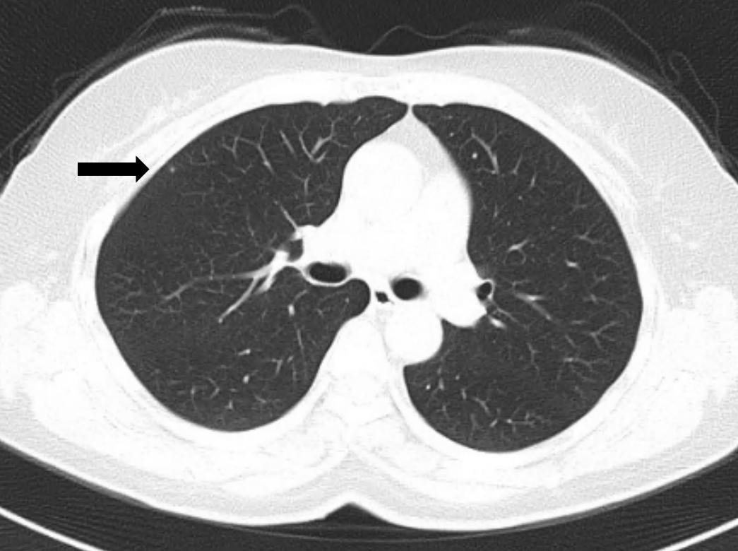 大蒜是肺结节发物吗,大蒜对肺结节有影响吗