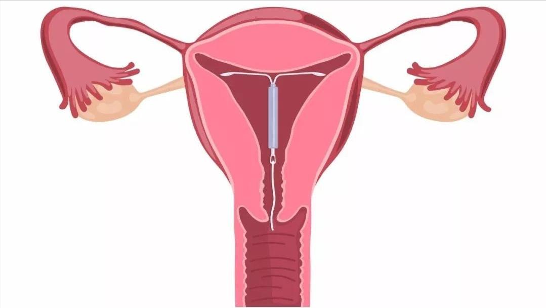 宫外孕都是有什么状况,宫外孕是怎么回事严重吗