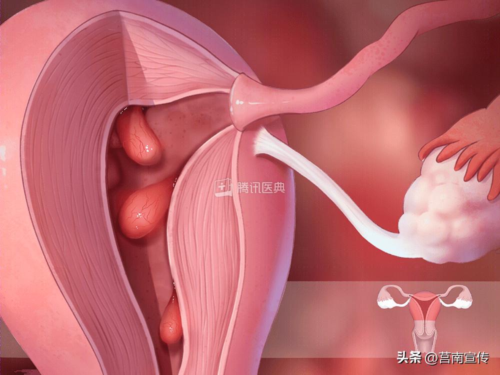 发现息肉，离癌有多远？