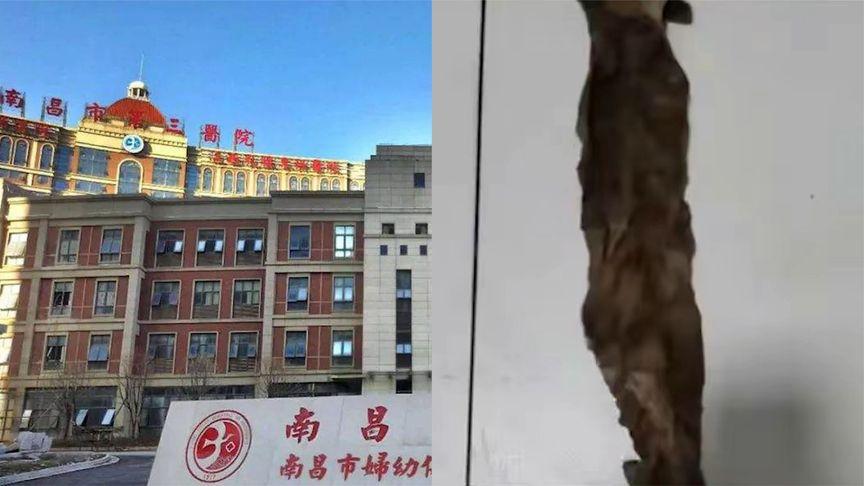 产妇体内遗留纱布,院方谈产妇体内留纱布