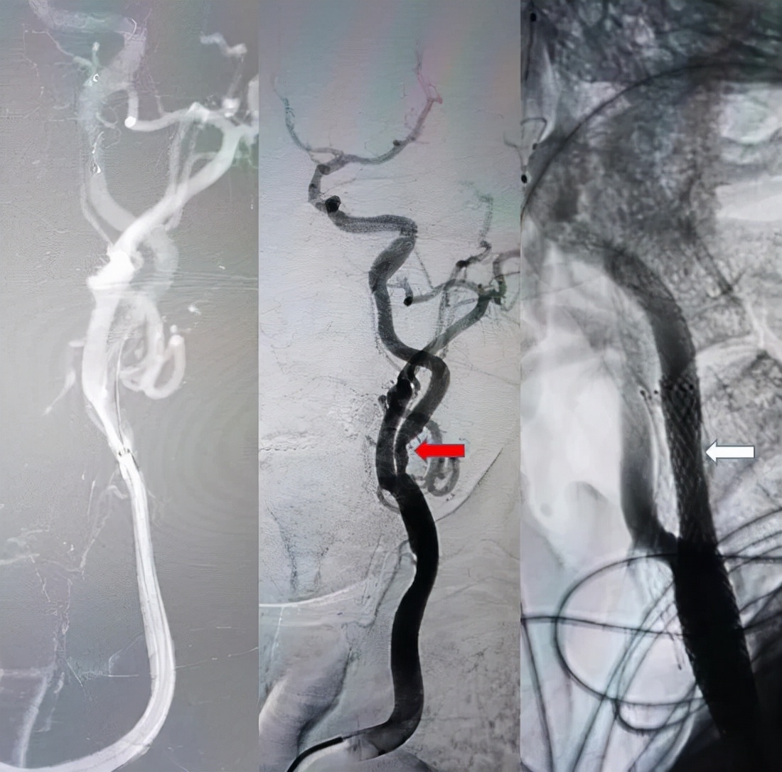 乘风破浪砥砺前行横版视频,首例经桡入路椎动脉支架置入术