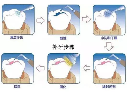 牙掉了补牙怎么补视频全过程,补牙是把牙全部拔掉还是直接补