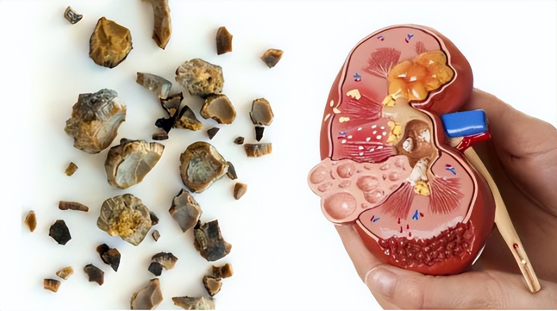 肾结石不能吃鸡蛋吗需要注意什么,肾结石鸡蛋不能吃还能吃什么