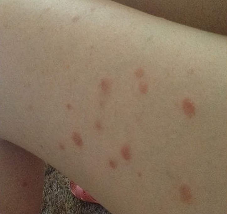 几块钱一瓶的“甲硝唑”，原来还有这些妙用，别白白错过了