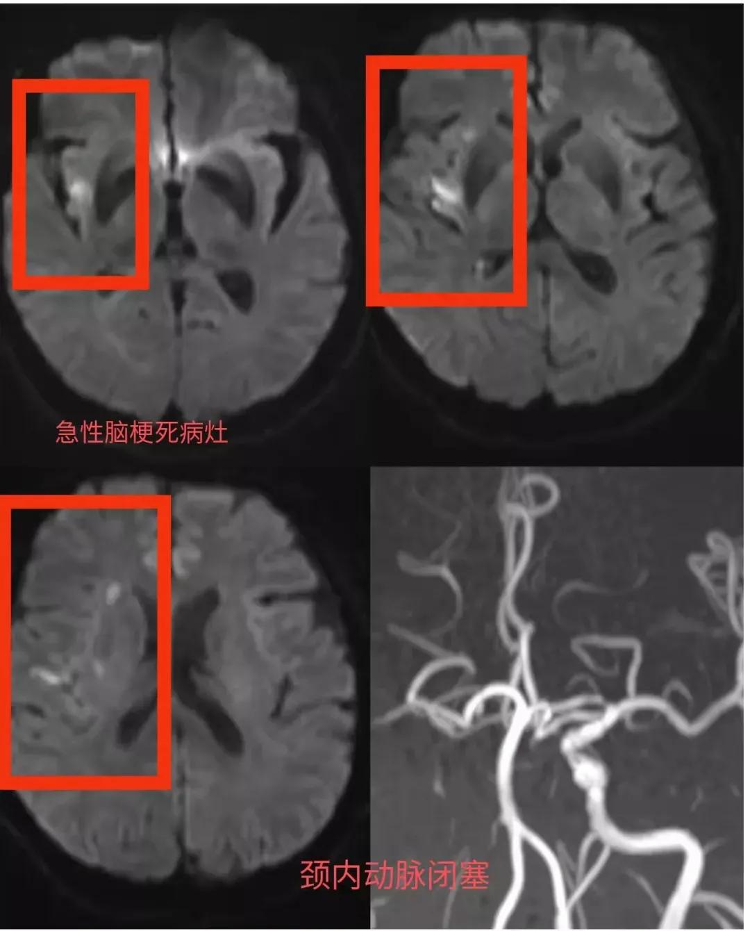 溶栓取栓争分夺秒,争分夺秒抢救脑梗