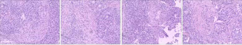 抗her2阳性治疗,双靶向治疗her2复发率