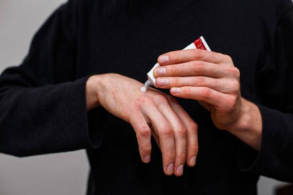 皮炎湿疹用药,外阴皮炎湿疹用药