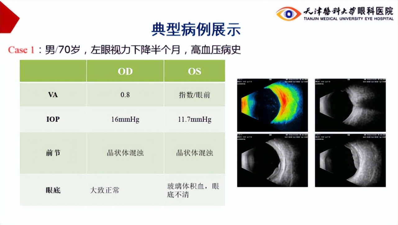李筱荣教授,天津医科大学眼科医院李筱荣