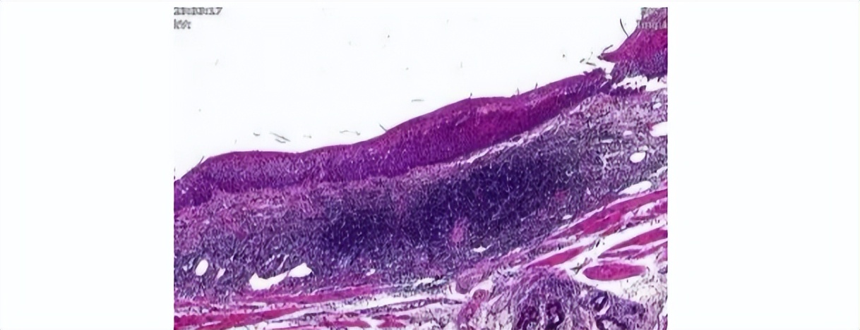 喉咙出现这些症状别大意！不是“咽炎”，可能是癌症上身！