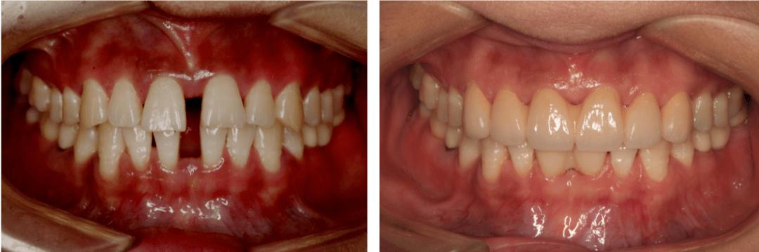 牙龈萎缩牙缝变大怎样缩小牙缝,洗完牙后牙缝大怎么缩小牙缝